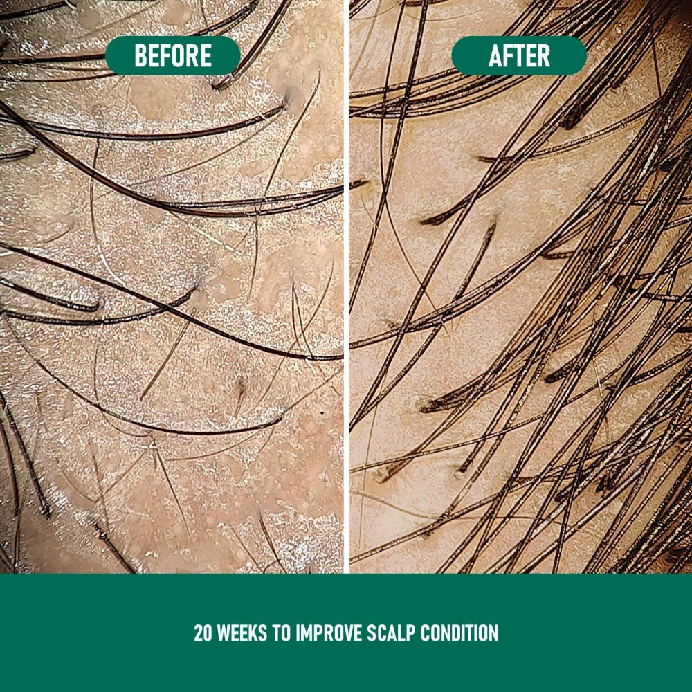 Minoxidil Anti-Hair Loss Mousse - Wellora