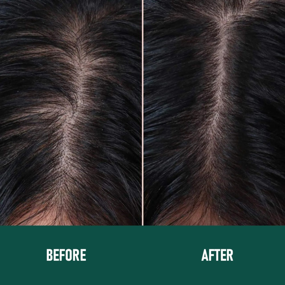 Minoxidil Anti-Hair Loss Mousse - Wellora